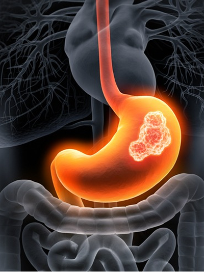 Representación del cáncer gastrico